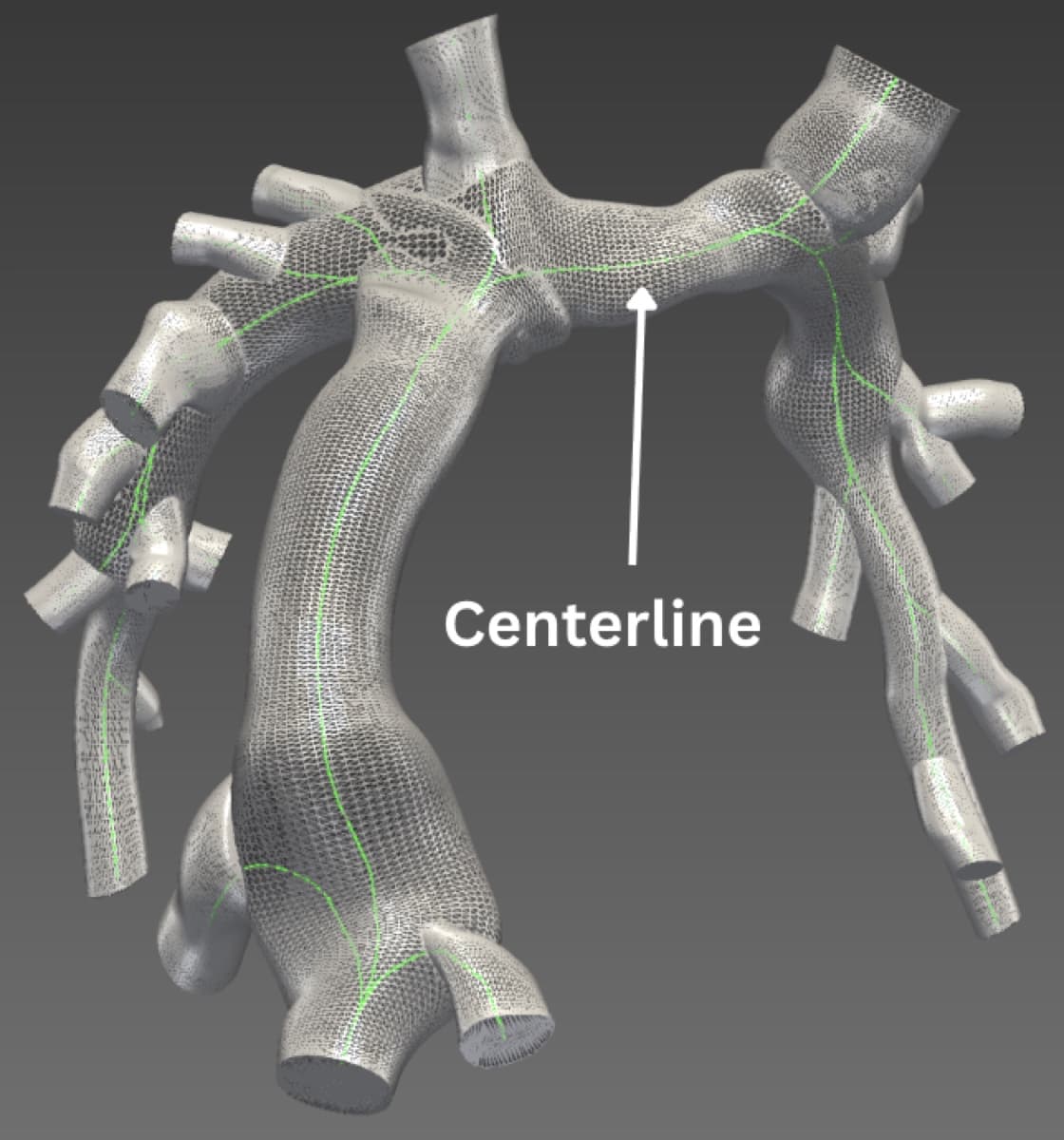 Fontan vascular model with an extracted centerline running through the reconstructed conduit