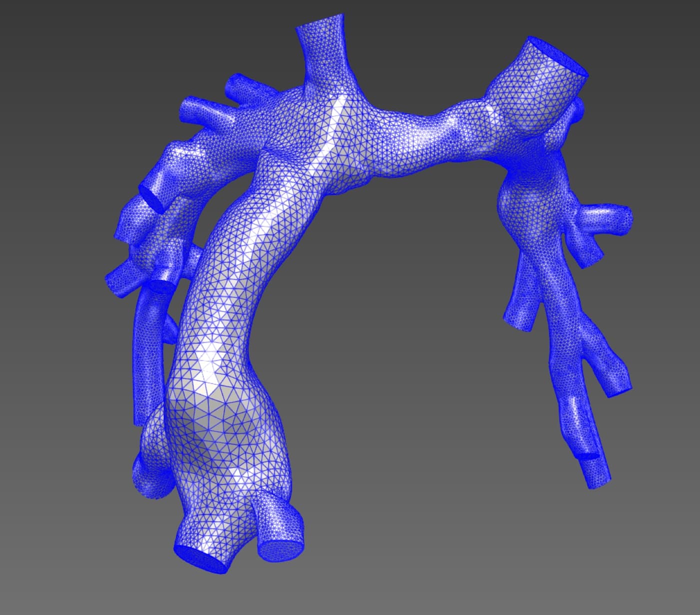 Tetrahedral volumetric mesh of a reconstructed Fontan vascular model