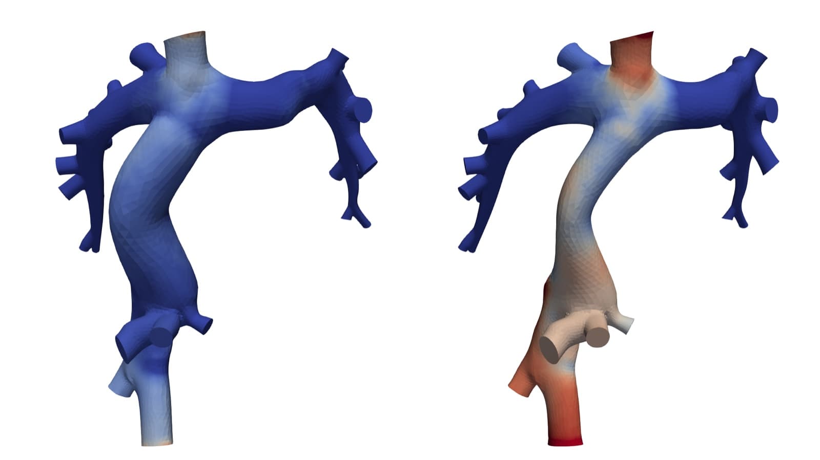 Simulated pressure field on a Fontan vessel model before and after virtual stenting, colored from low (blue) to high (red) pressure