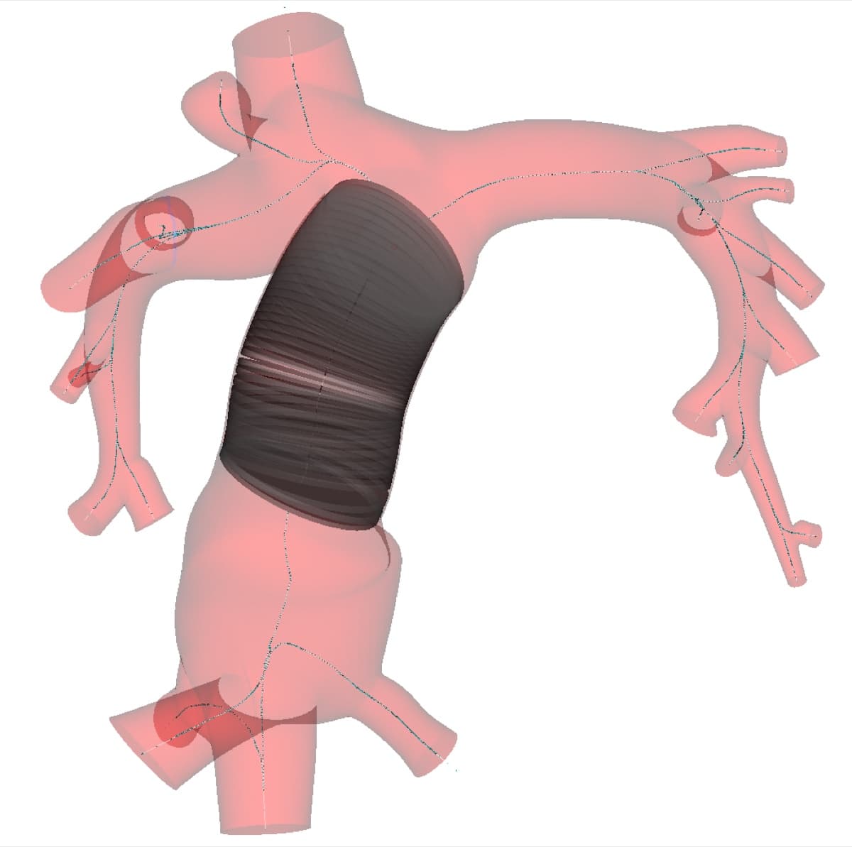 Close-up of the virtual stent expansion region overlaid on a translucent Fontan vessel model, with capped inlet and outlet faces