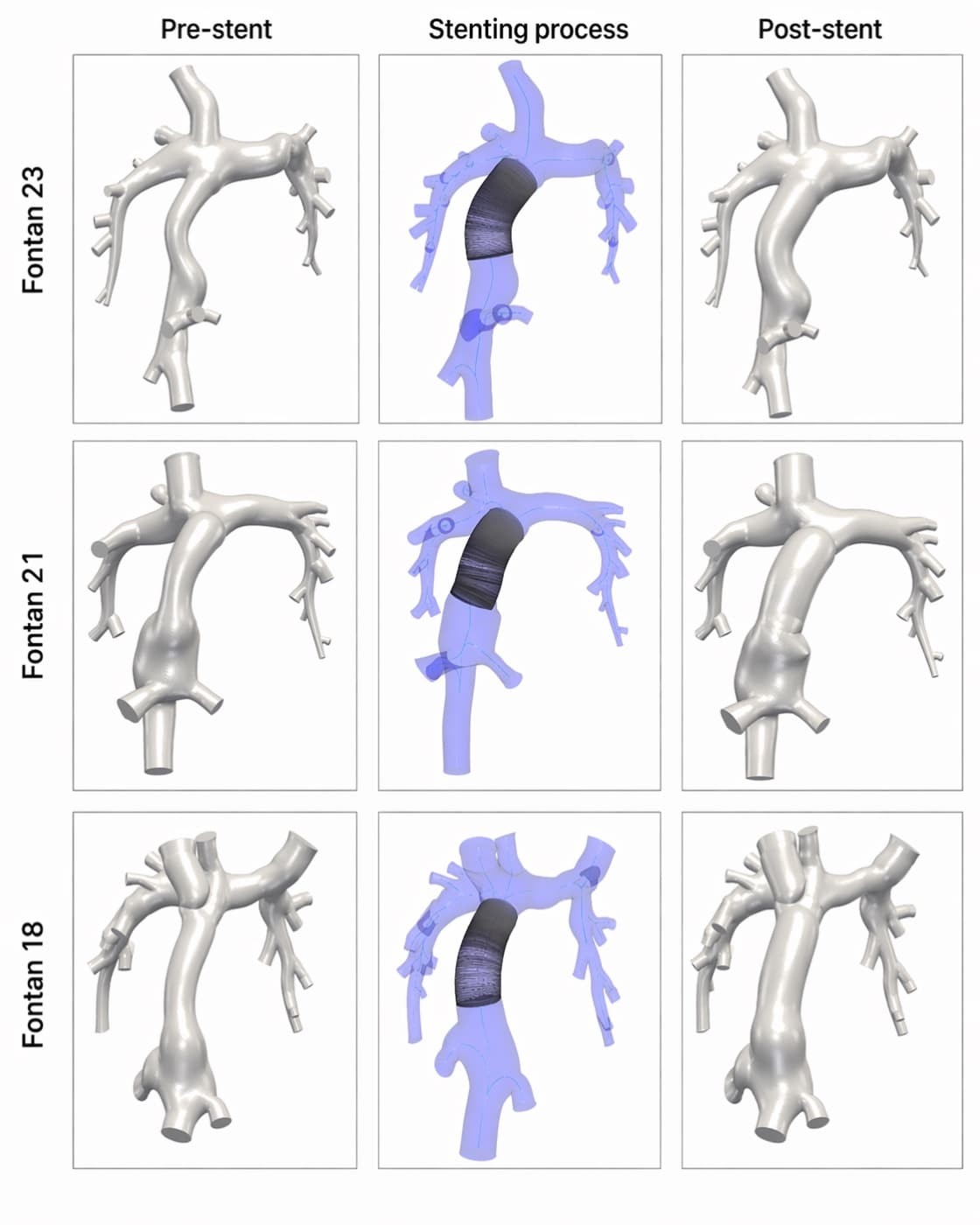 Pre-stent, stenting-process, and post-stent geometry comparison for Fontan patients 18, 21, and 23